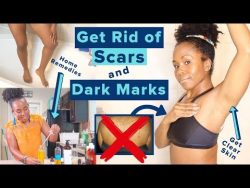 Get Rid of Hyperpigmentation, Scars, Dark Spots & Boil Scars on Your Body FAST | *Highly Req ...