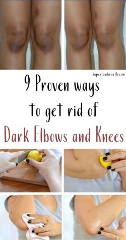 9 Proven ways to get rid of Dark elbows and knees with Home remedies