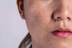 What is Hyperpigmentation? What to Know About Dark Spots and Skin Discolouration