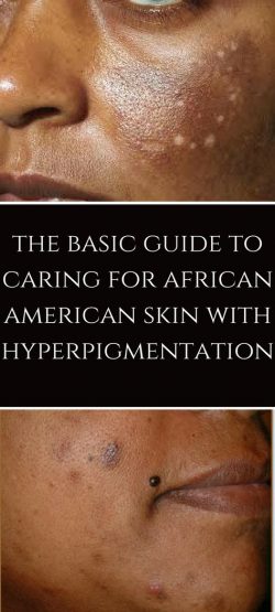 The Basic Guide to Caring For African Skin With Hyperpigmentation