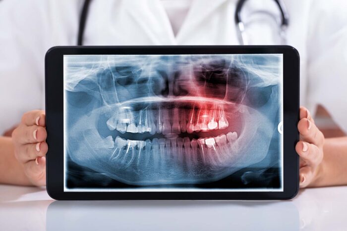 Periapical X-Ray | Bitewing X-rays