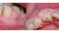 What is an Abscess Tooth | Abscess Tooth Symptoms, Treatment Causes