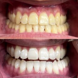 Teeth Whitening in Houston, Tx | Teeth Bleaching
