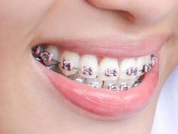 What Are The Best Braces Colors? | Colored Braces and Bands