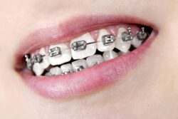 Advantages Of Adult Orthodontics