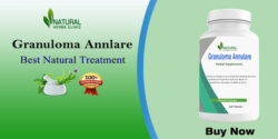 How to Use Natural Remedies for Granuloma Annulare Relief